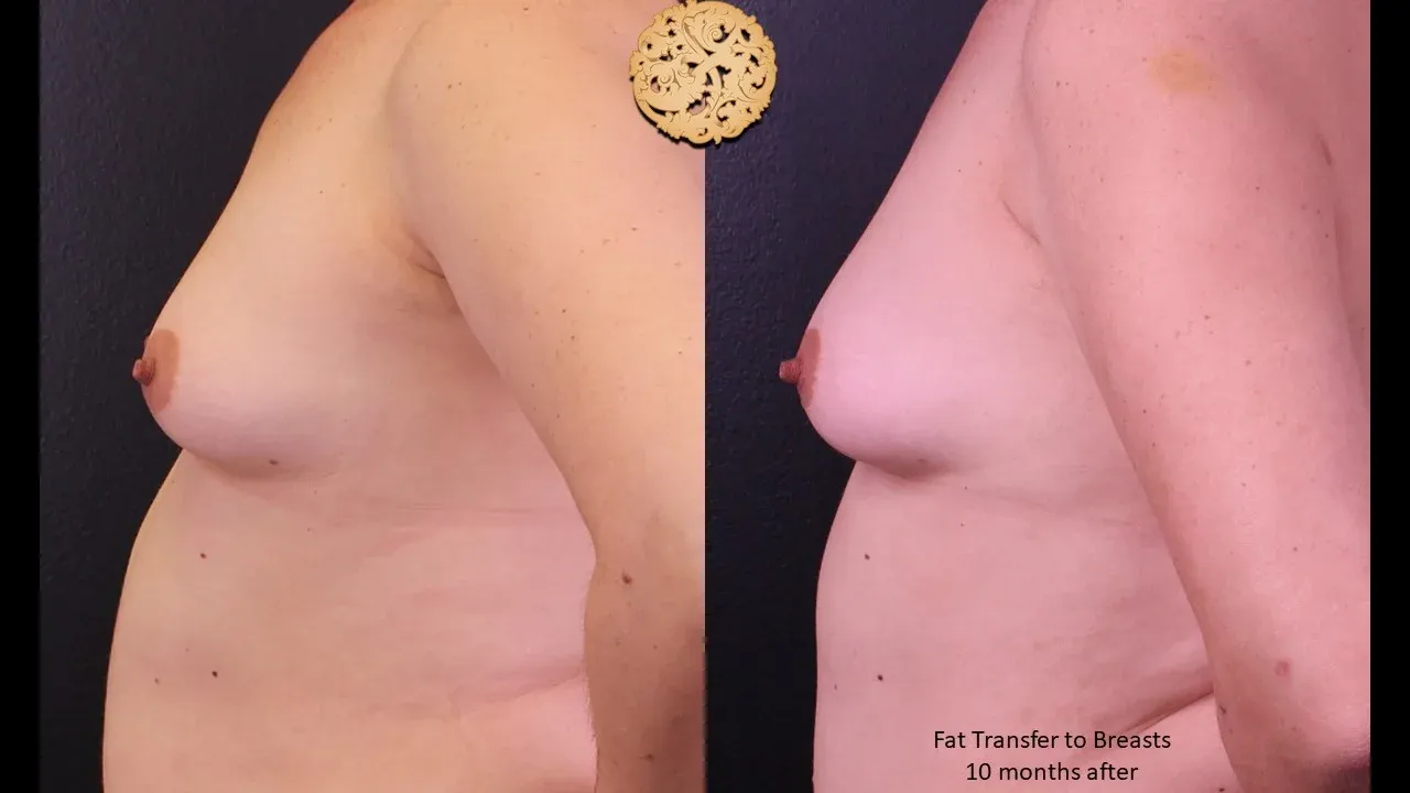 Breast Lift Before & After