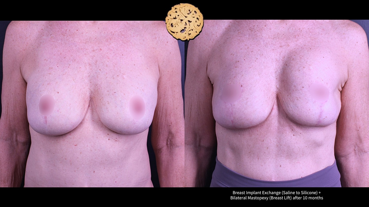 Before and after breast implants and lift.
