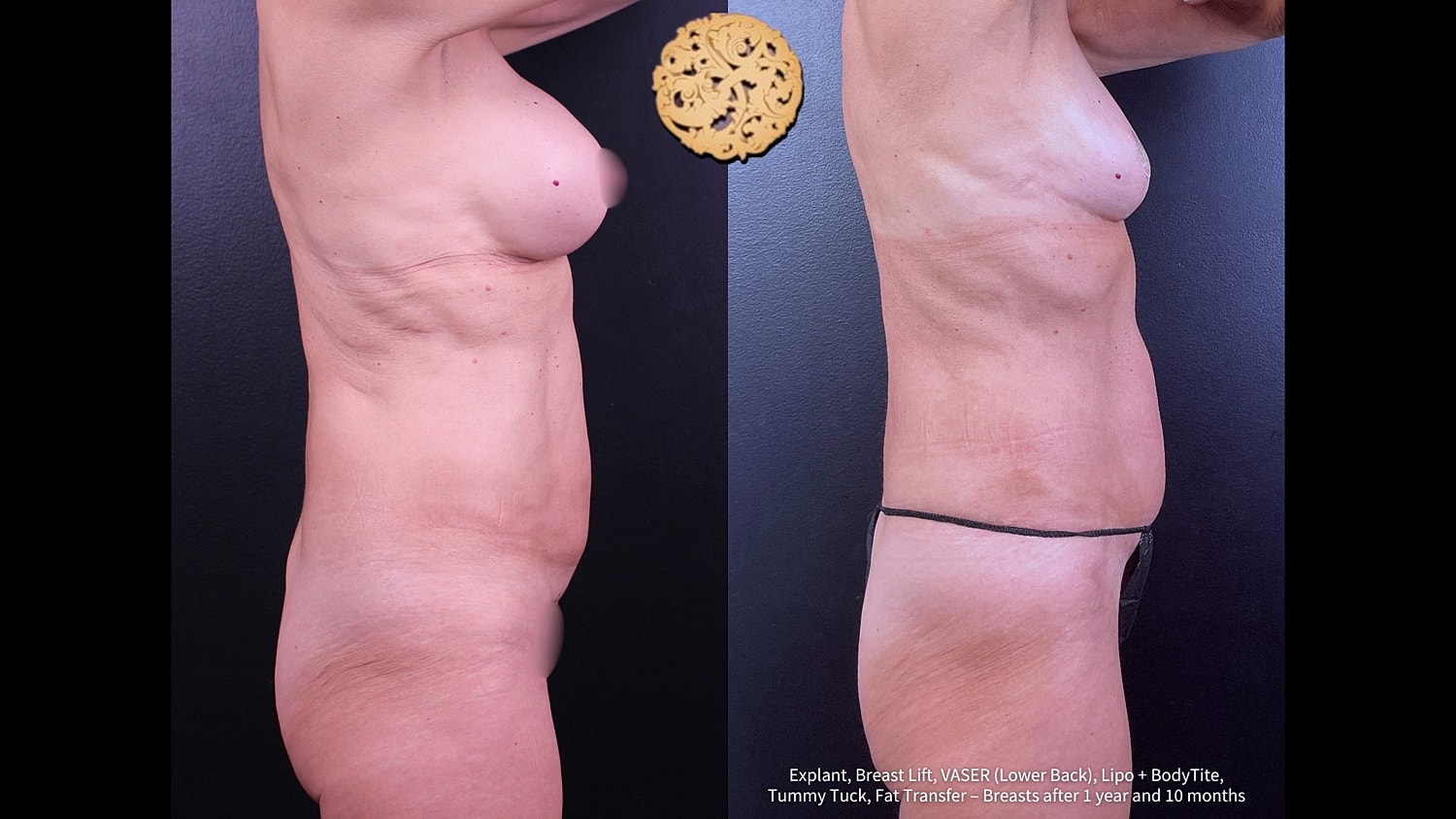 Breast Lift Before & After