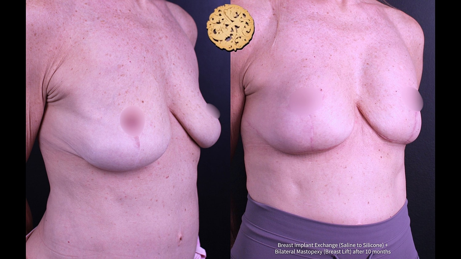 Breast surgery results after 10 months healing.