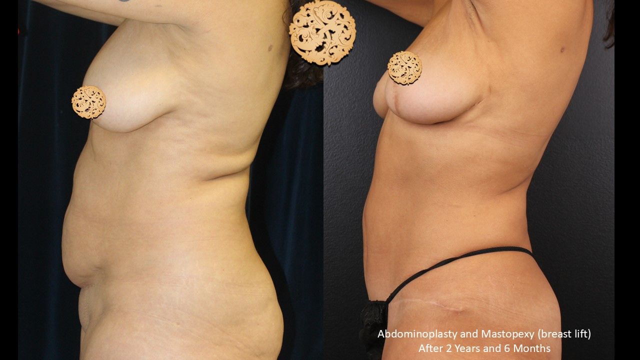 Breast Lift Before & After