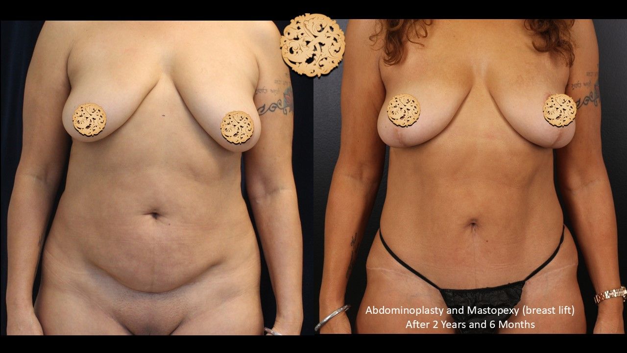 Breast Lift Before & After