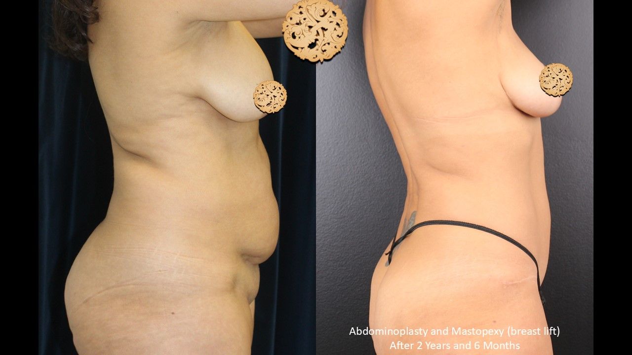 Breast Lift Before & After