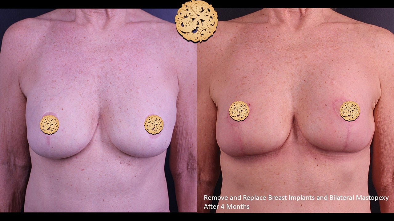 Before and after breast surgery results comparison.