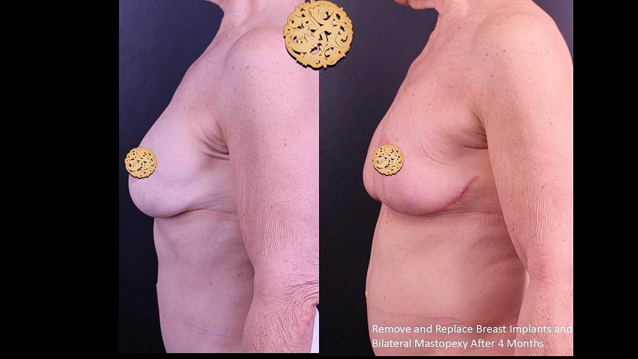 Breast surgery results comparison, before and after.
