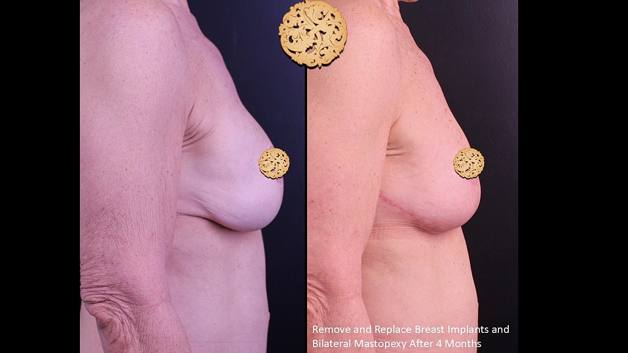 Post-surgery breast augmentation transformation, before and after.