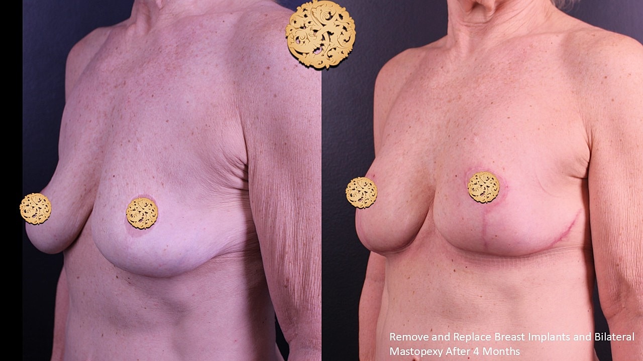 Breast surgery transformation before and after images.