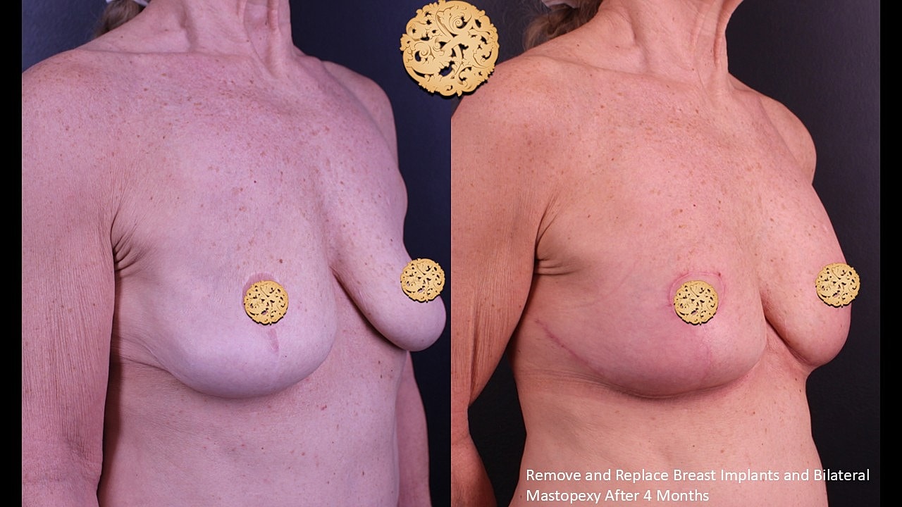Breast surgery before and after comparison image.