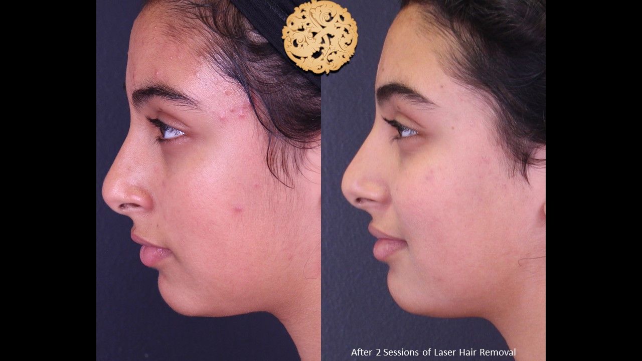 Laser Hair Removal Before & After