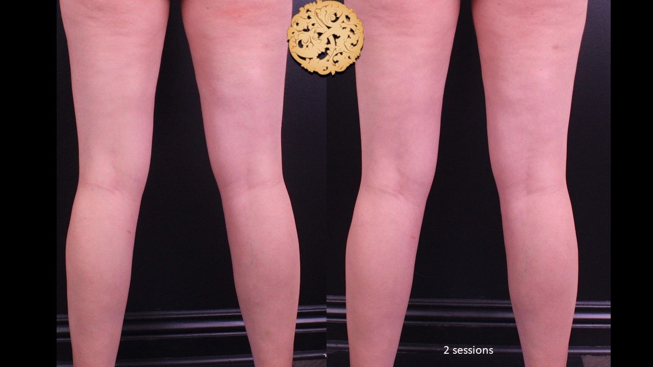 Laser Hair Removal Before & After