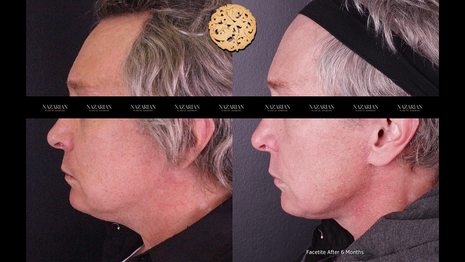 Facetite Before & After