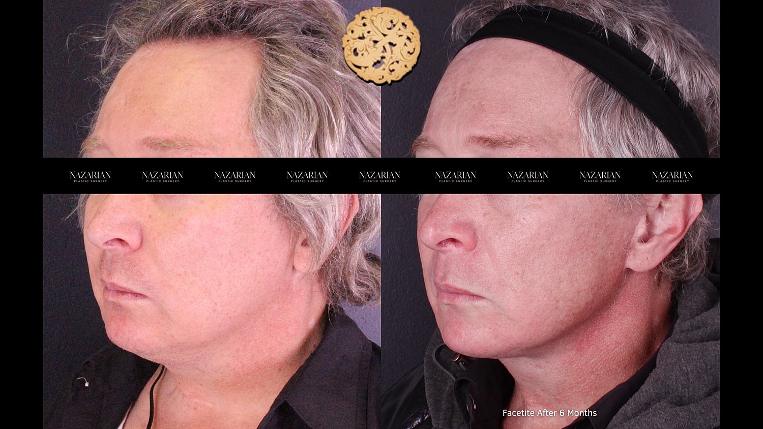 Facetite Before & After