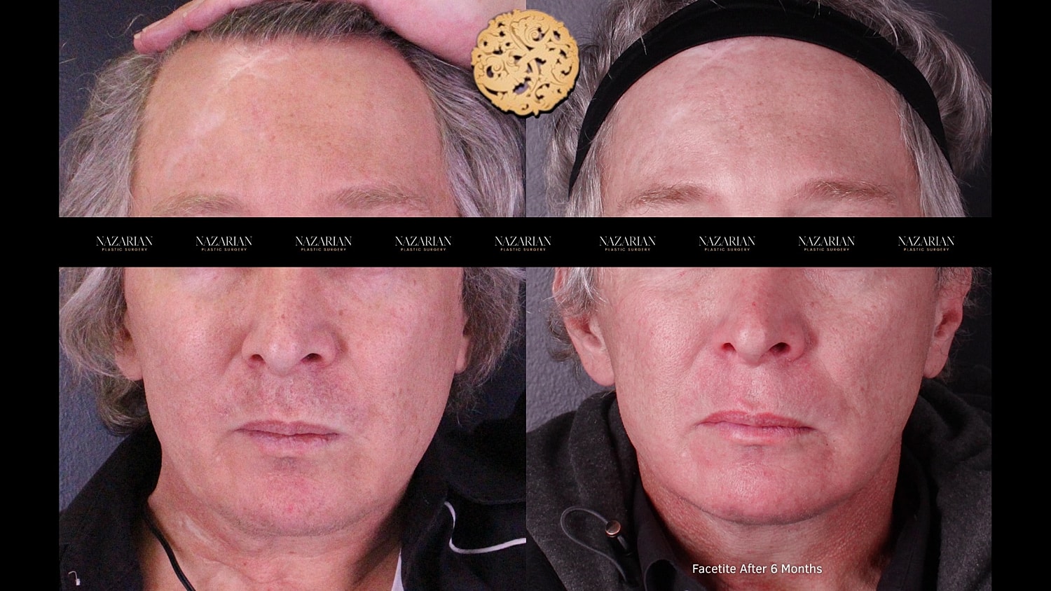 Facetite Before & After