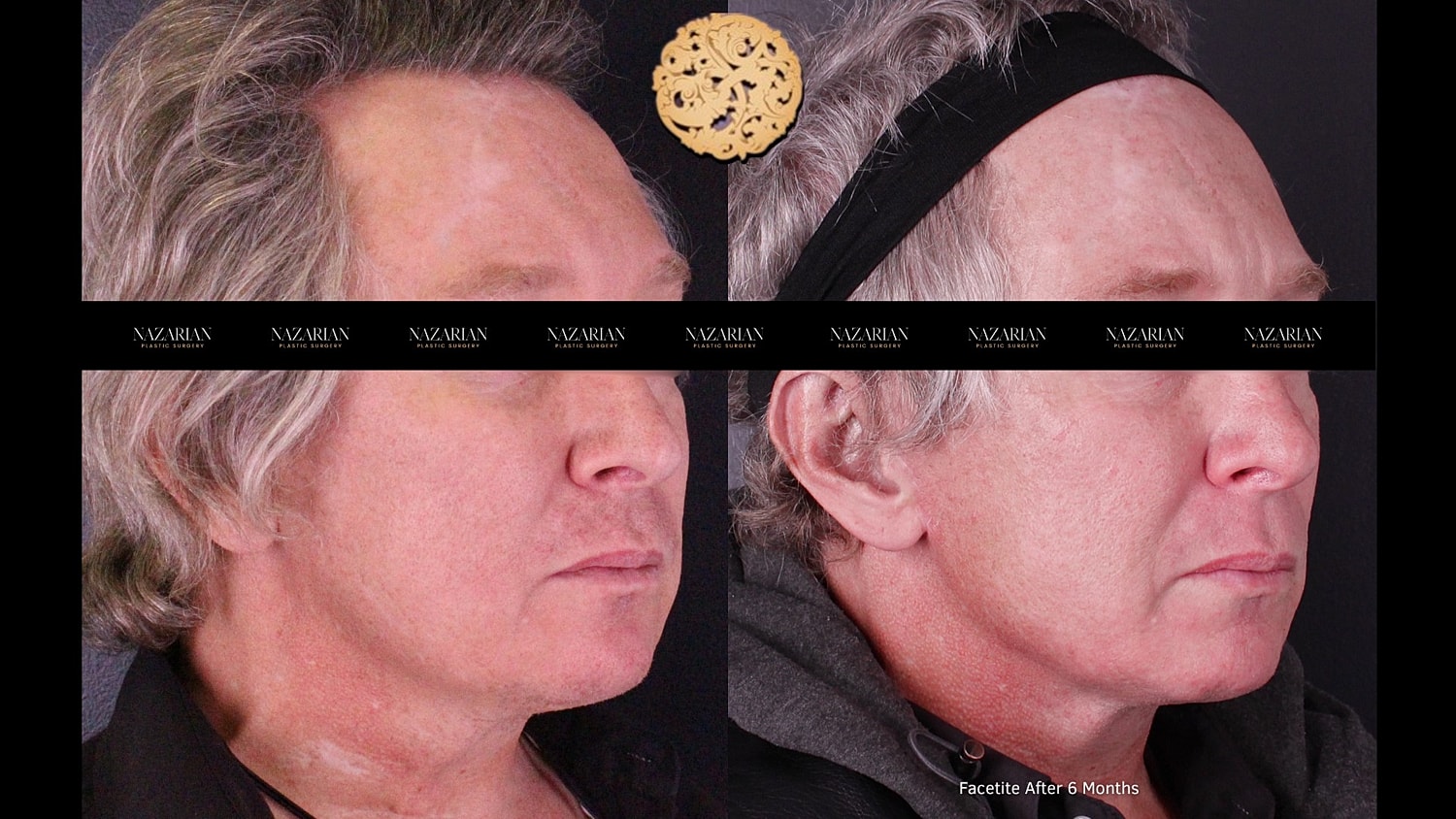 Facetite Before & After