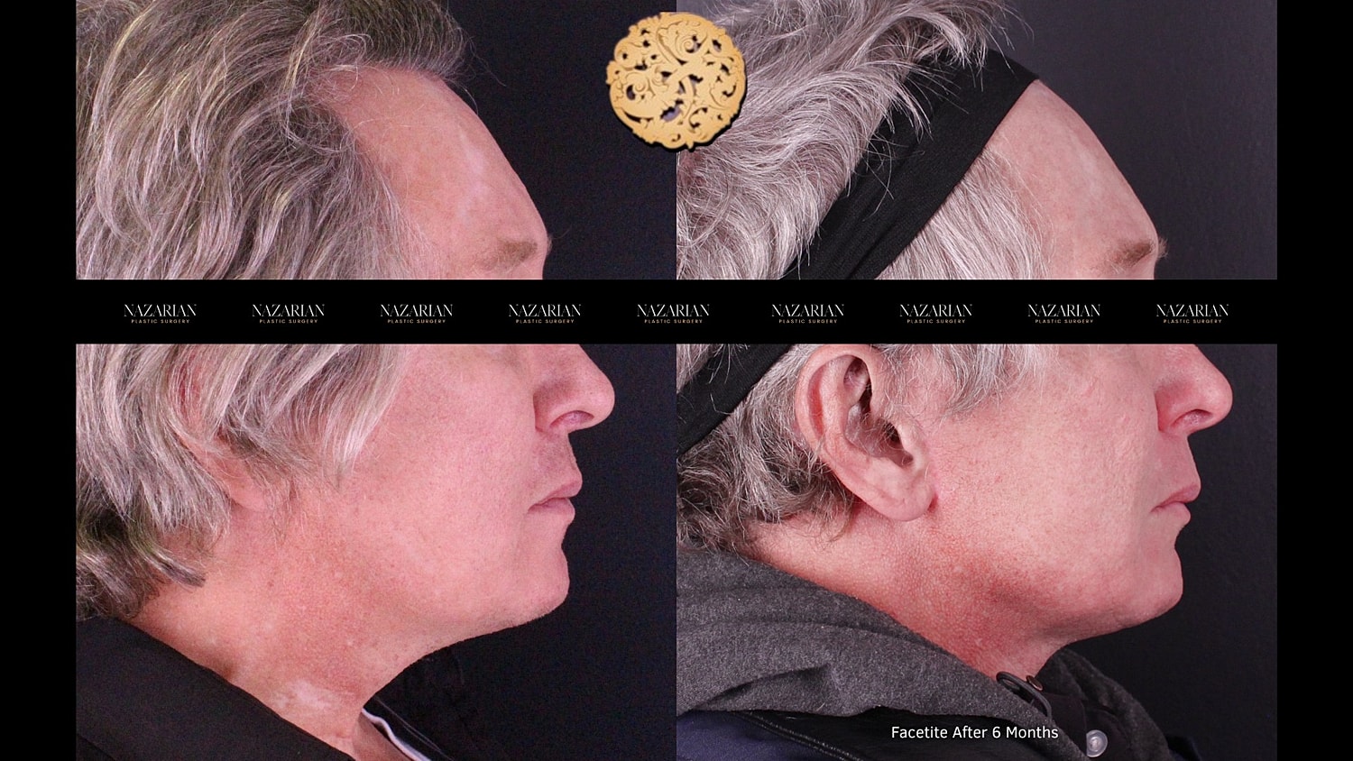 Facetite Before & After
