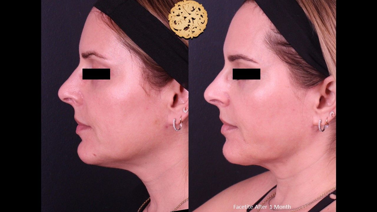 Facetite Before & After