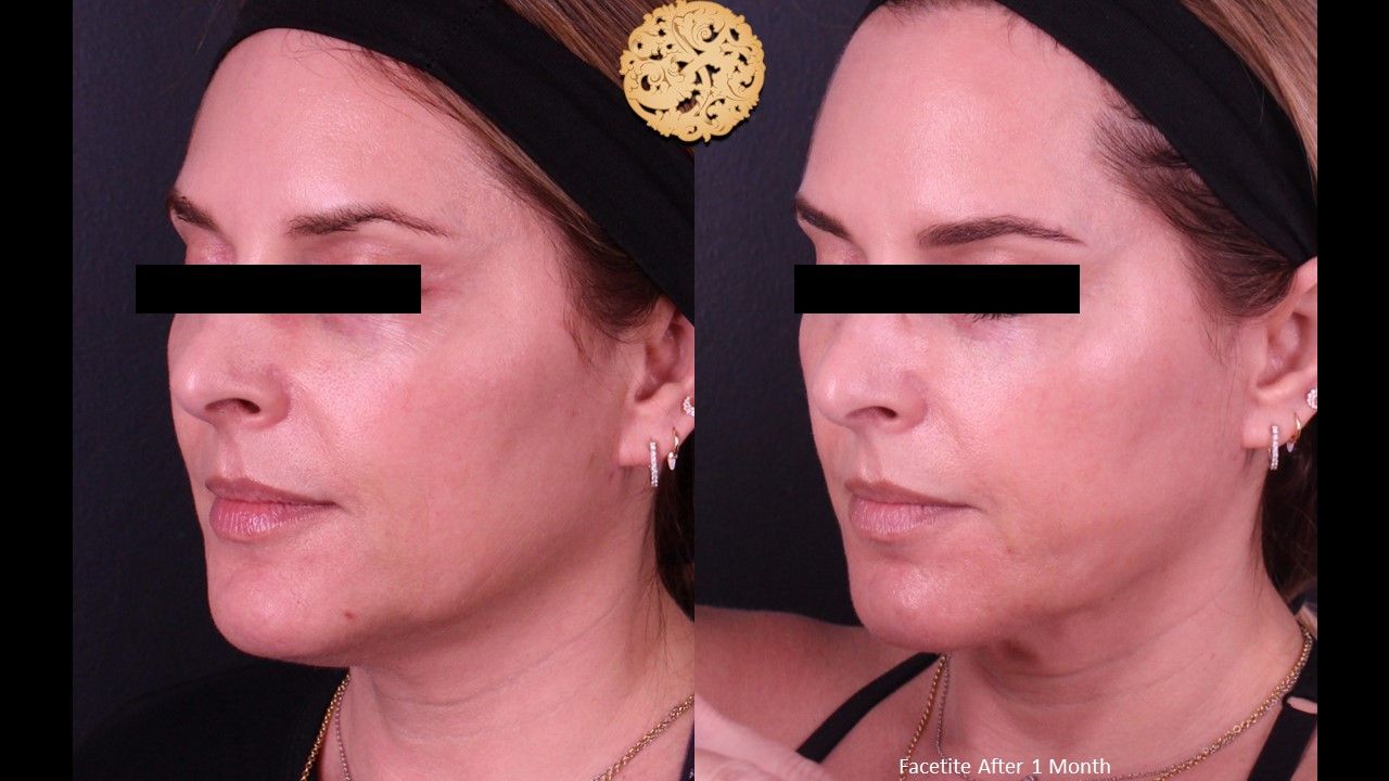 Facetite Before & After