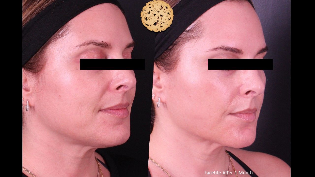 Facetite Before & After