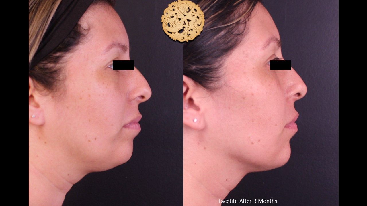 Facetite Before & After
