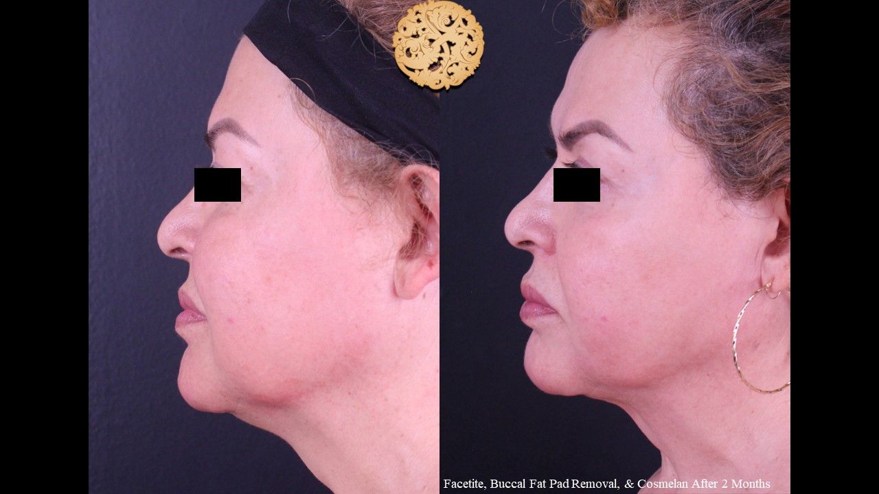 Facetite Before & After