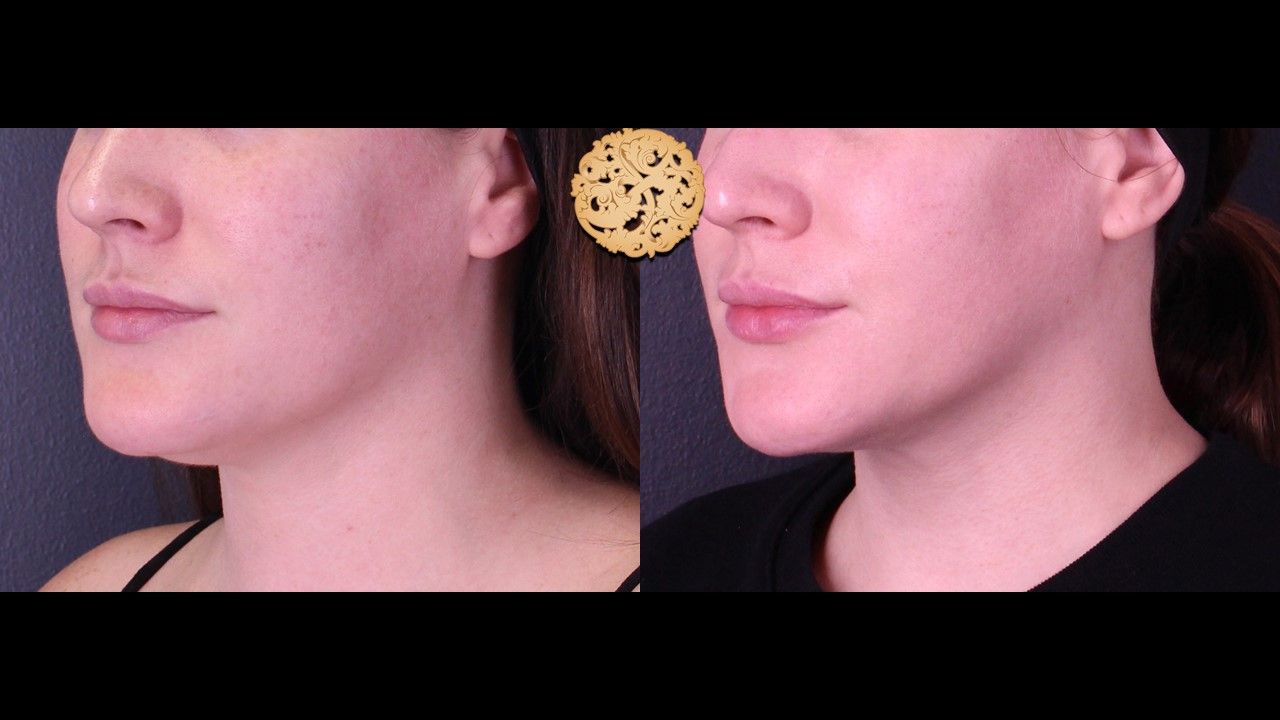 Facetite Before & After