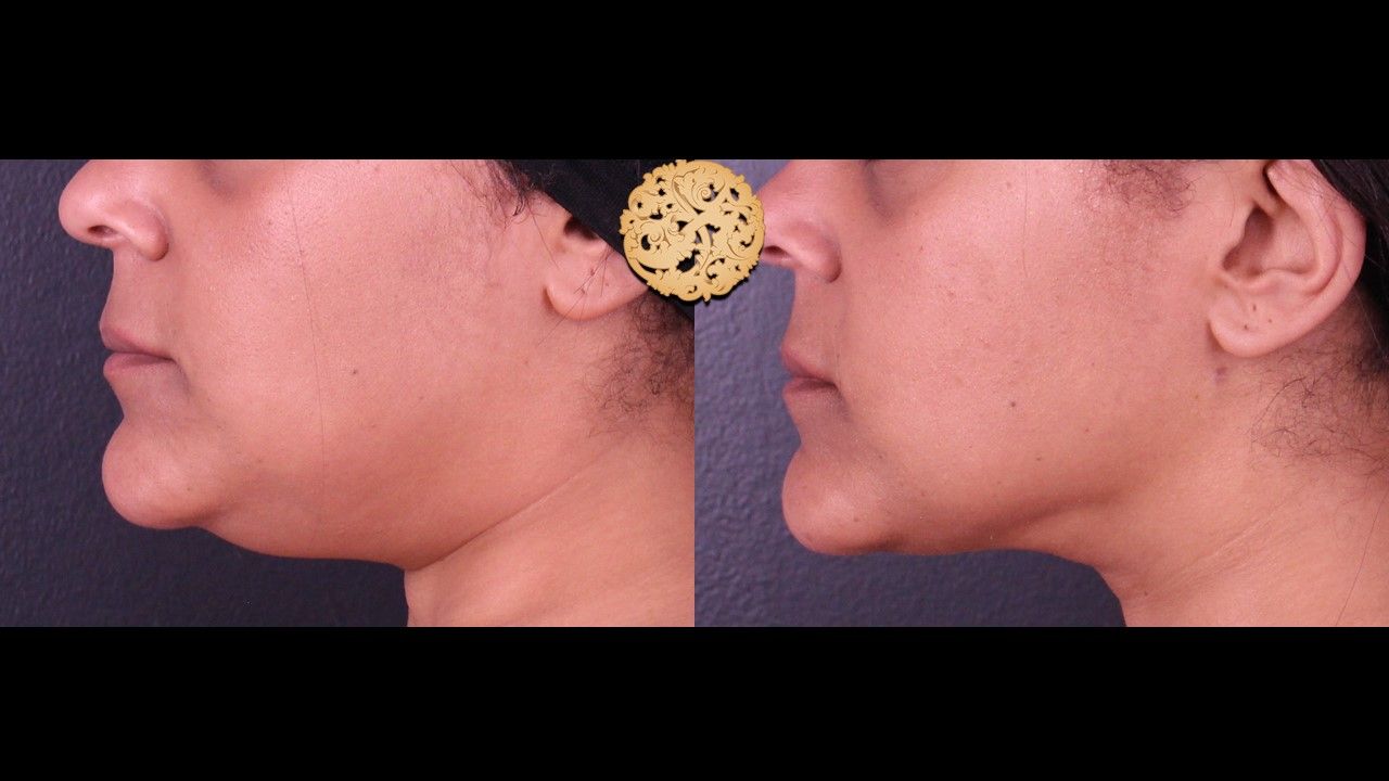 Facetite Before & After