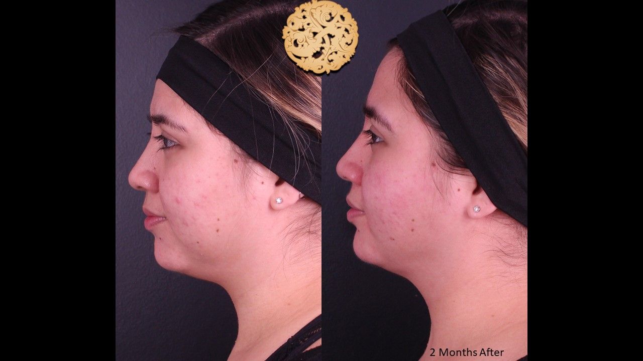 Facetite Before & After