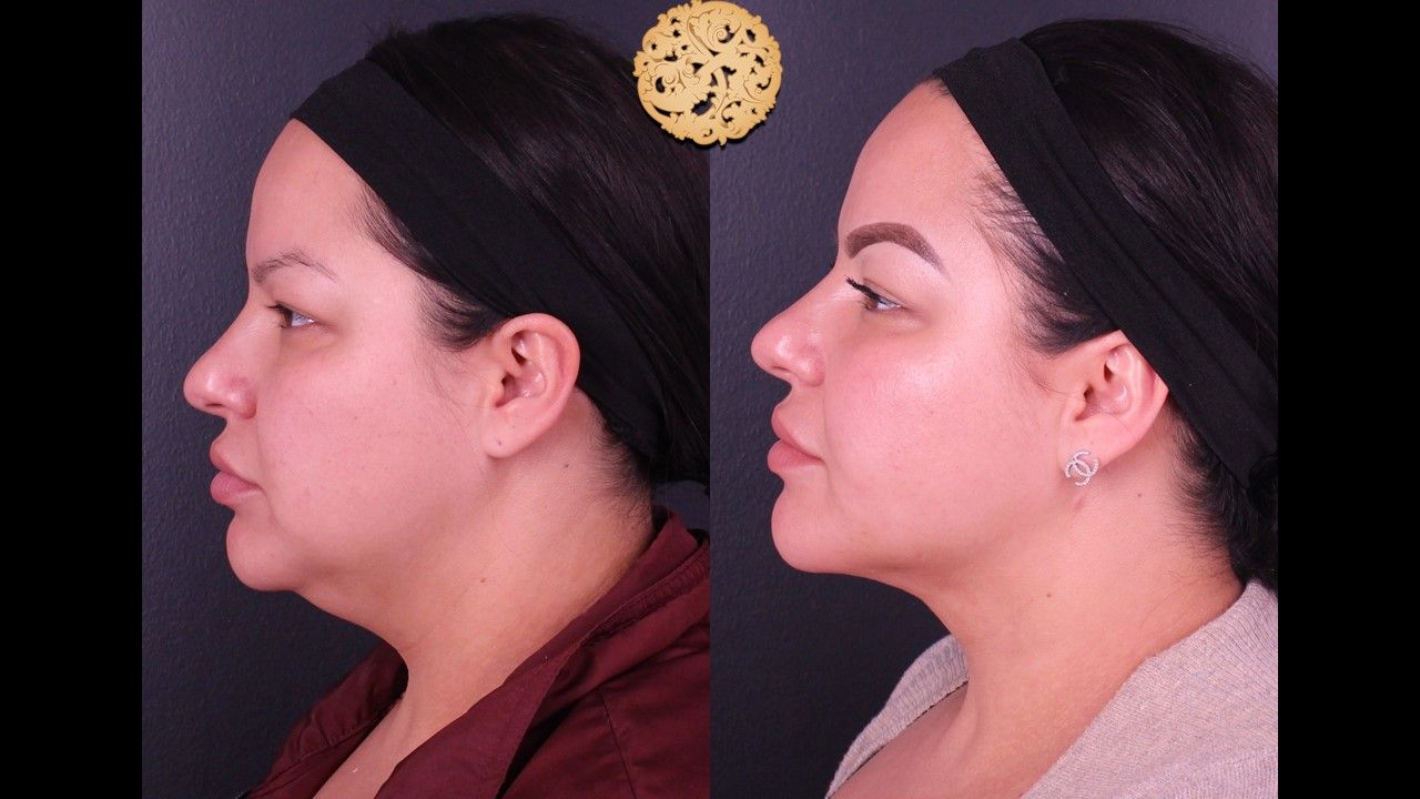 Facetite Before & After