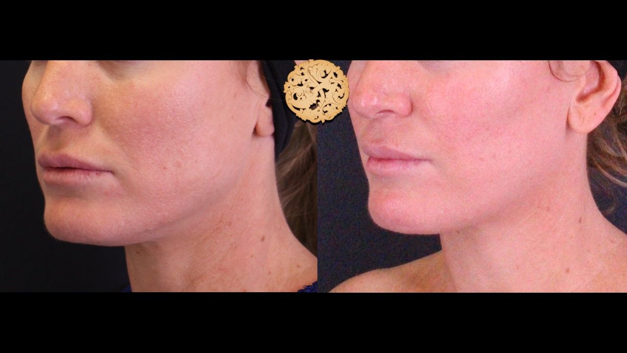 Facetite Before & After