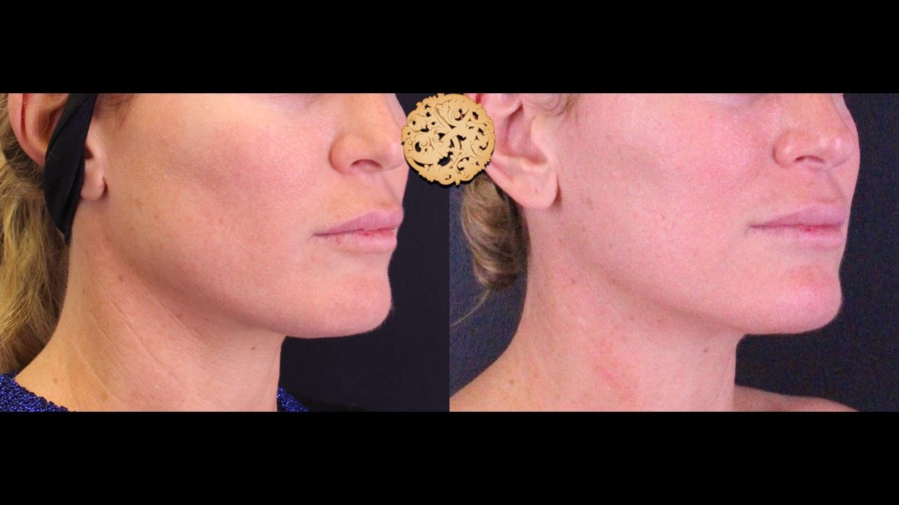 Facetite Before & After