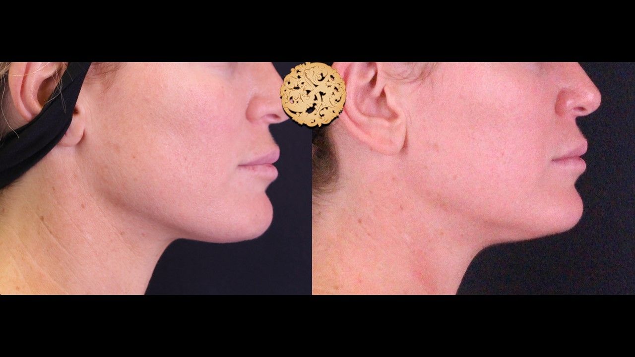 Facetite Before & After