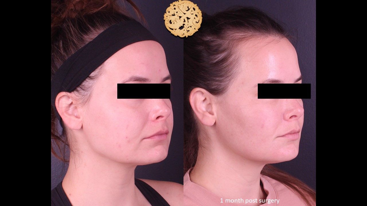 Facetite Before & After