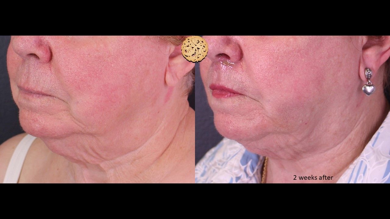 Facetite Before & After