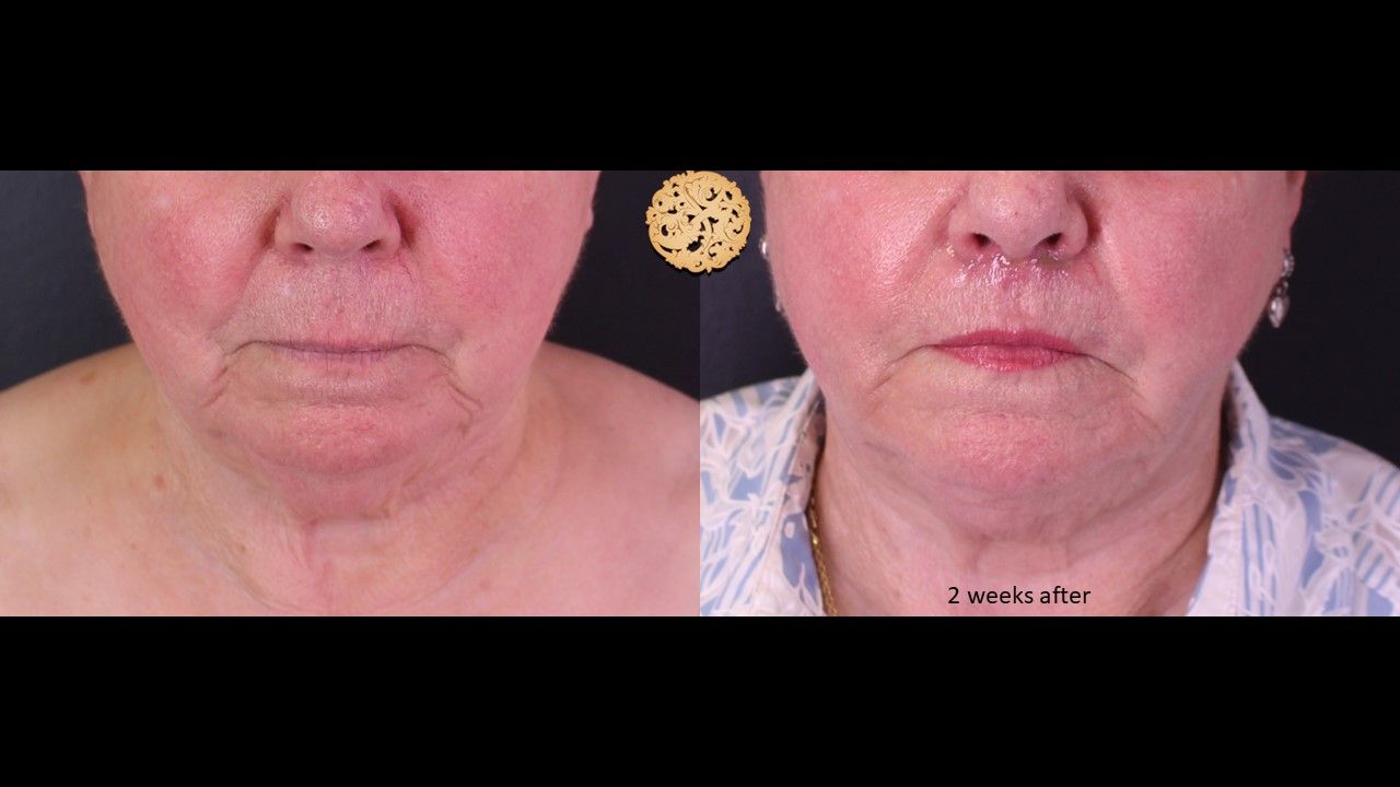 Facetite Before & After