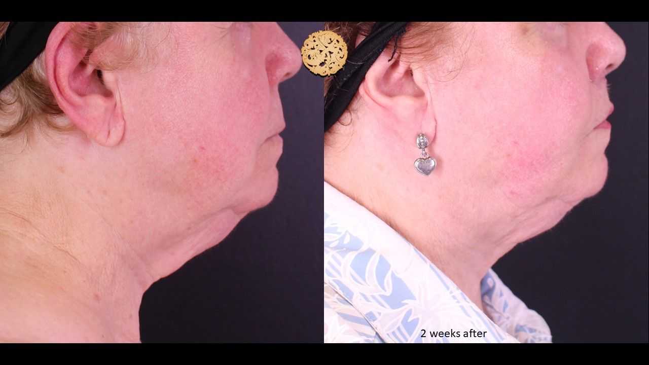 Facetite Before & After