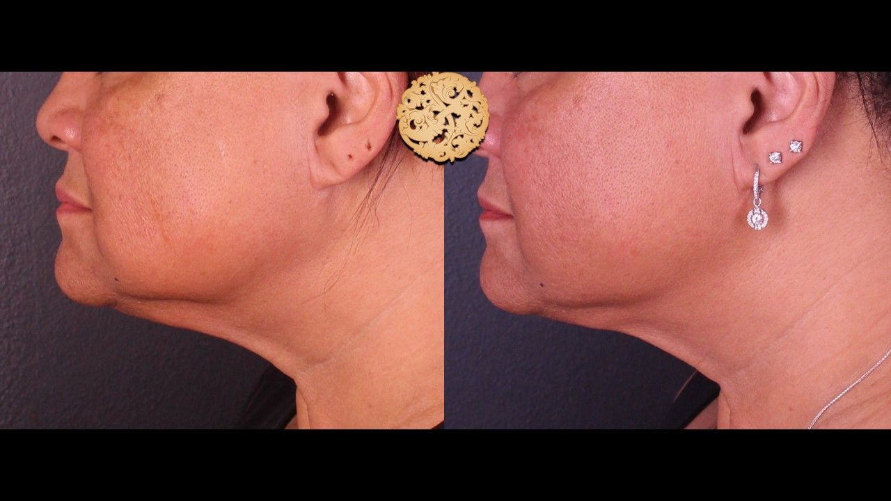 Facetite Before & After