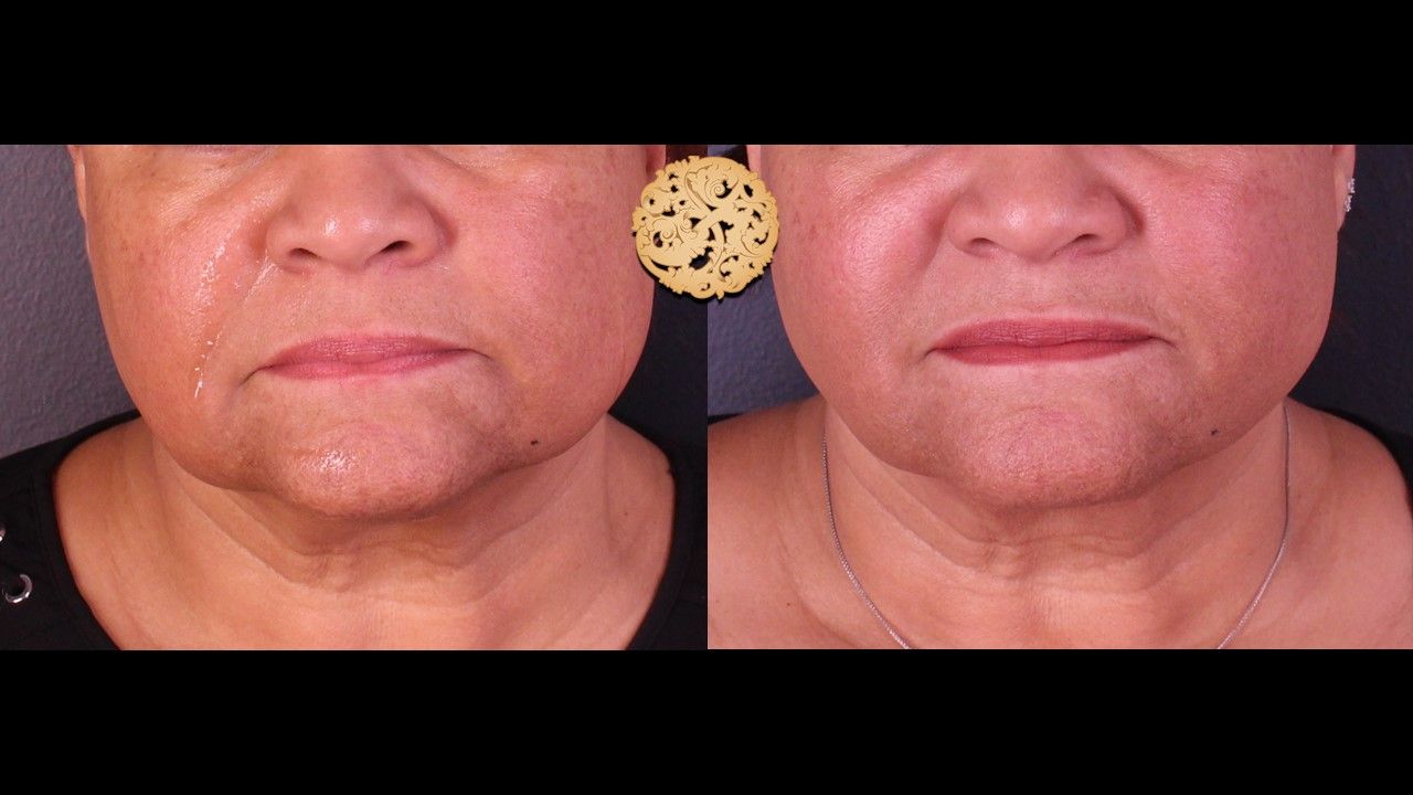 Facetite Before & After