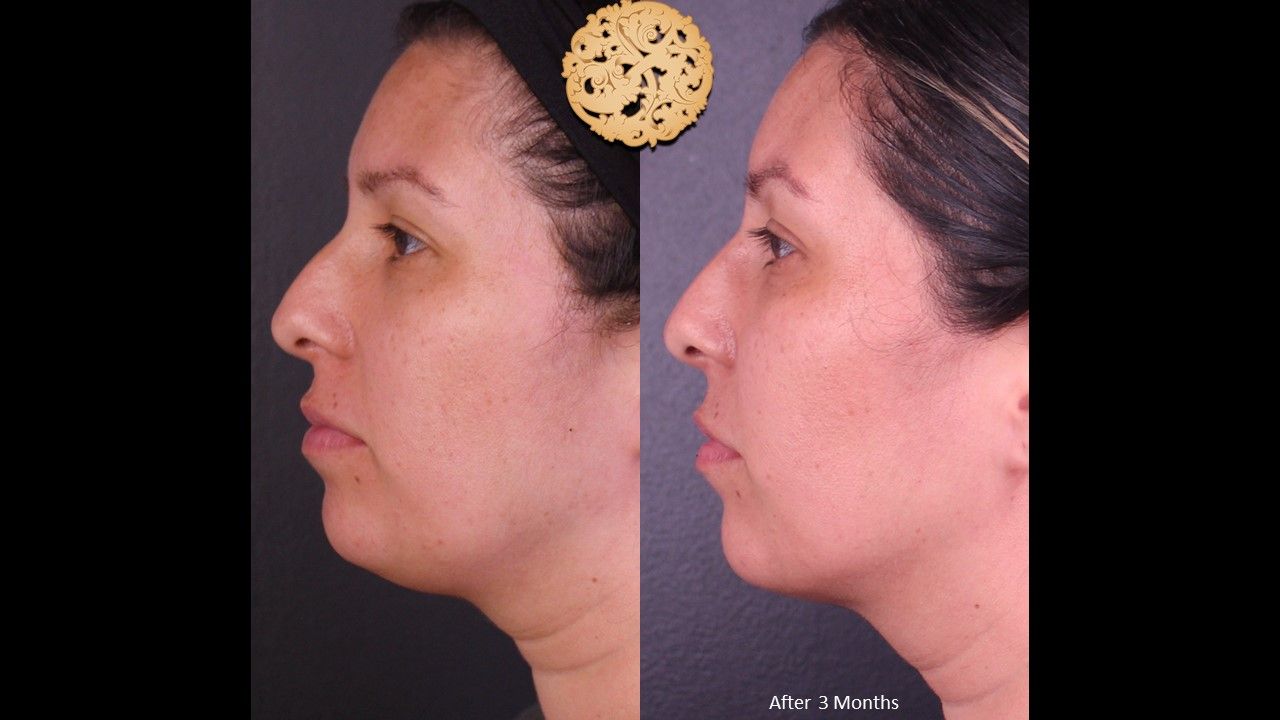 Facetite Before & After