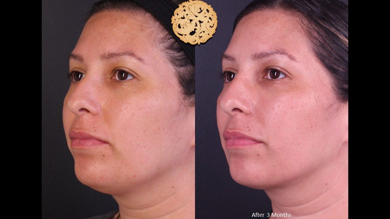 Facetite Before & After