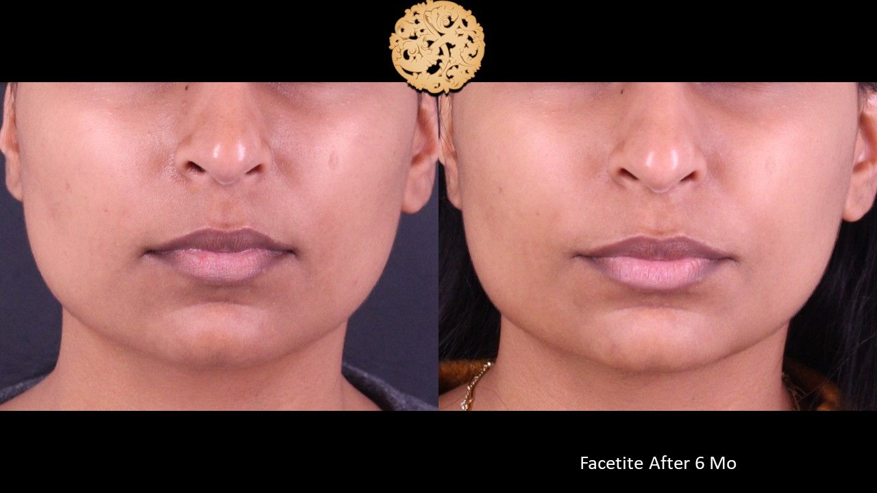Facetite Before & After