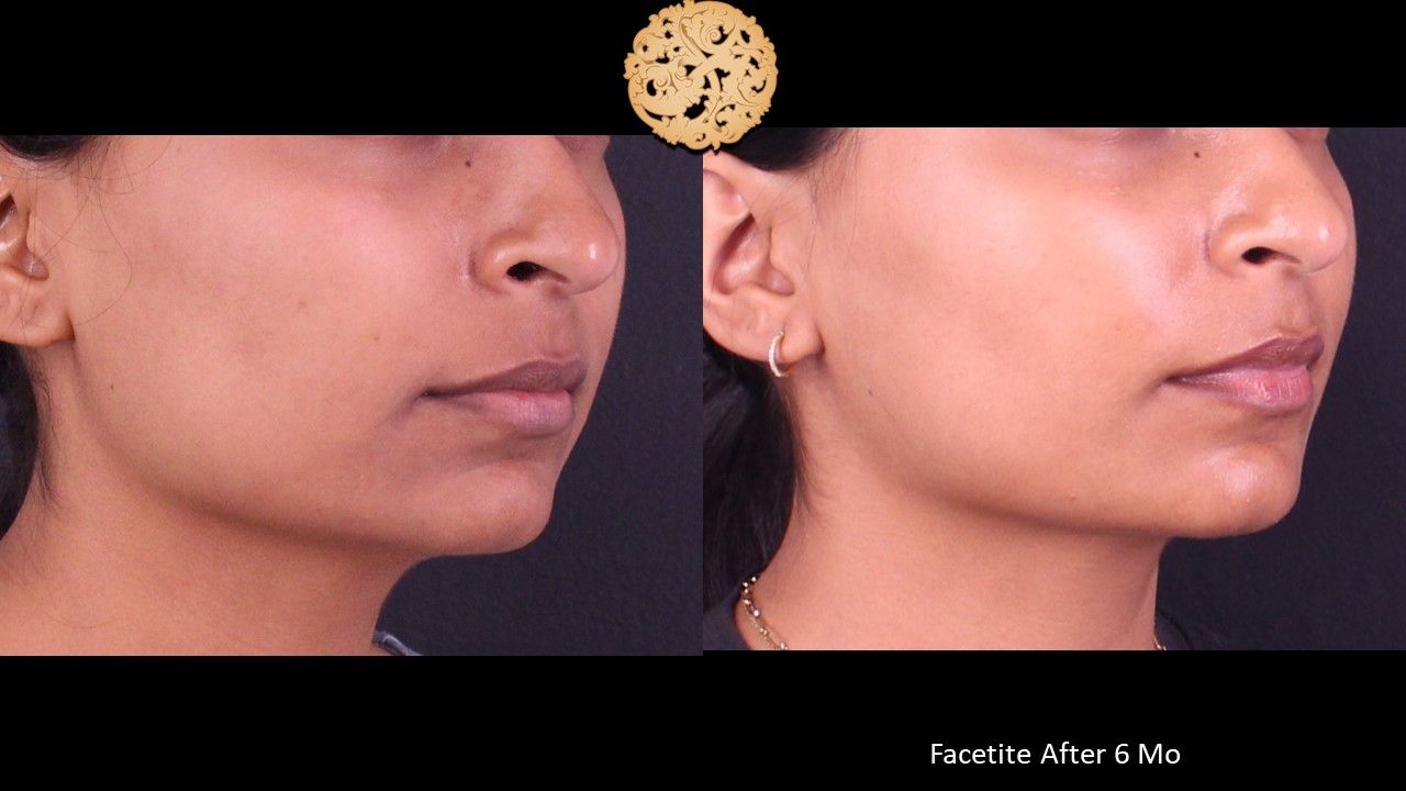 Facetite Before & After