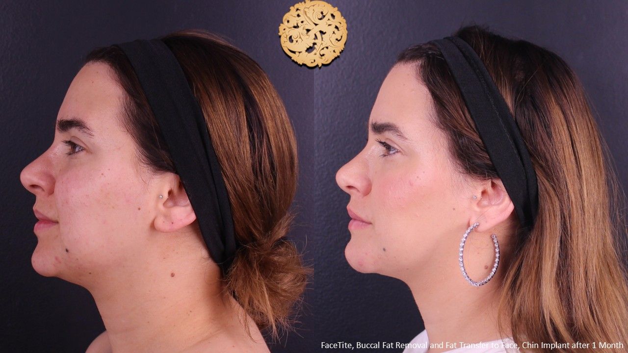 Facetite Before & After