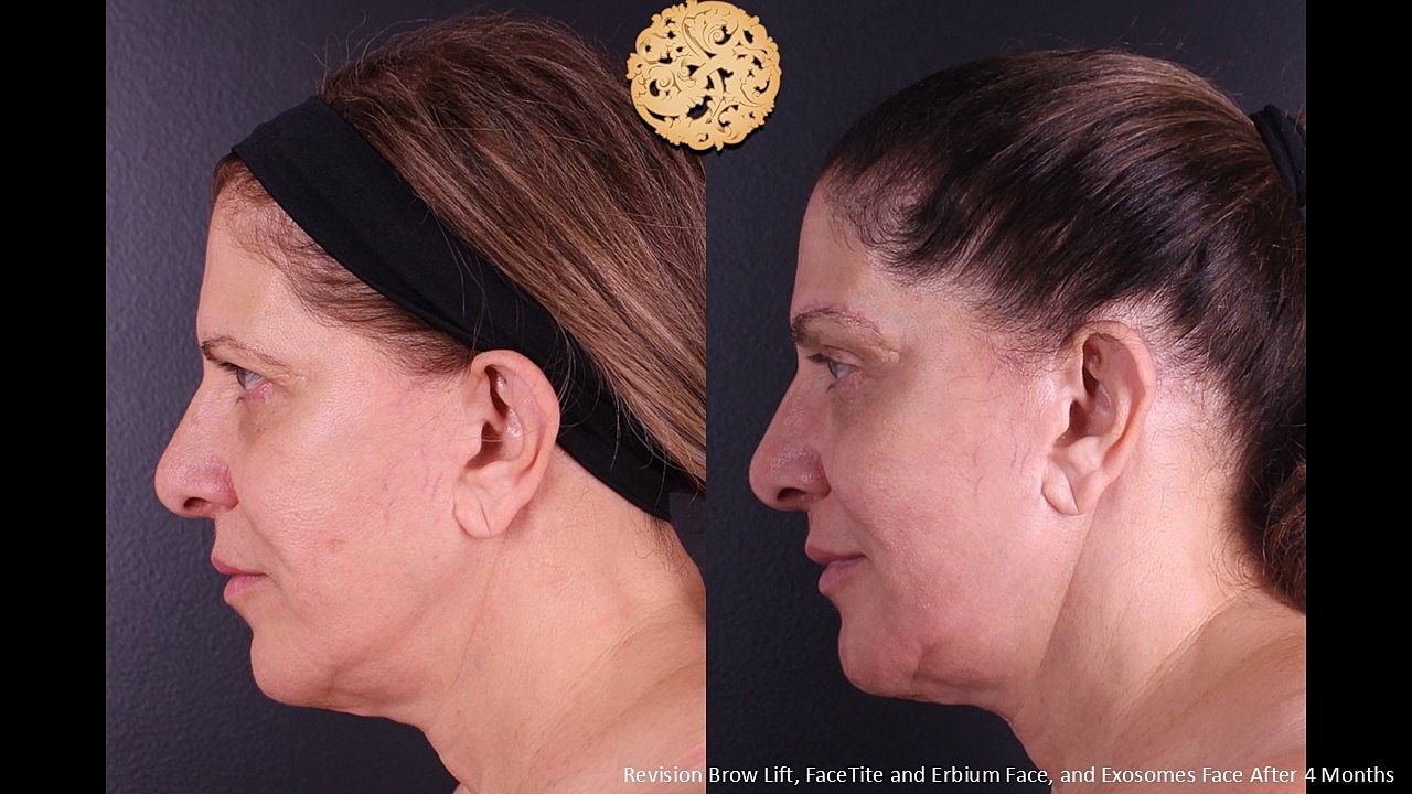 Facetite Before & After