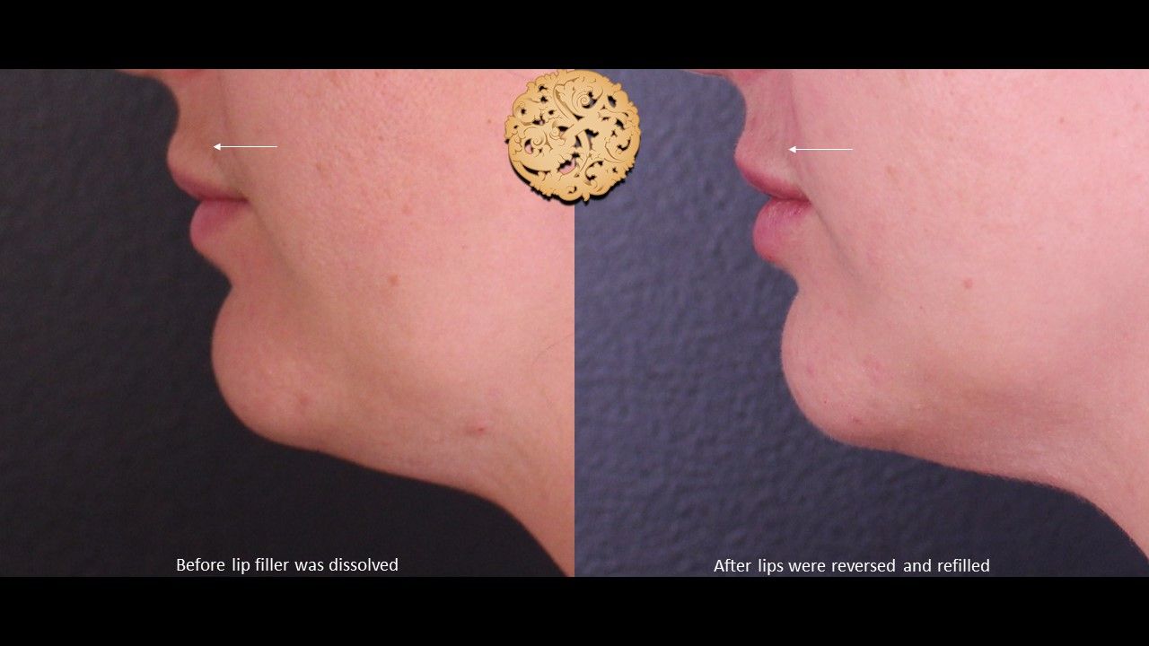 Filler Reversal Before & After