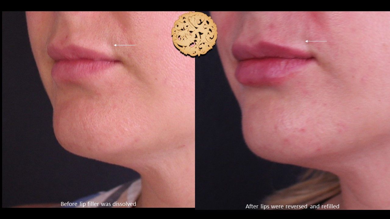 Filler Reversal Before & After