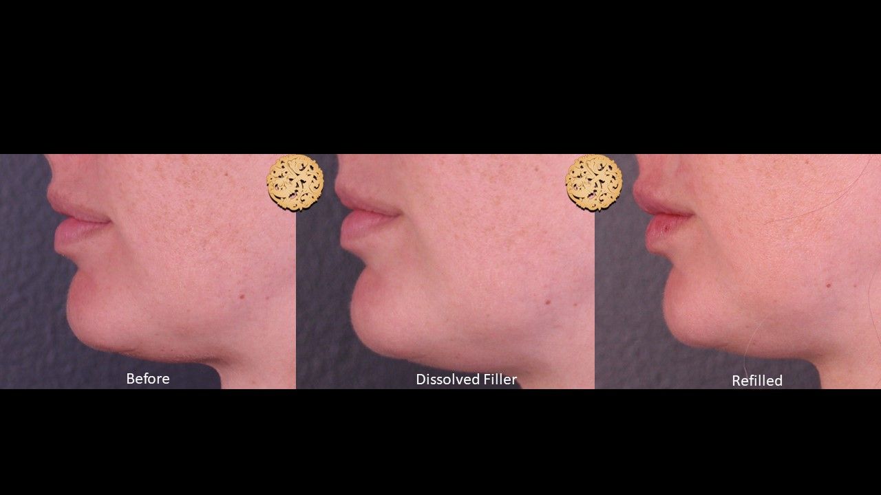 Filler Reversal Before & After