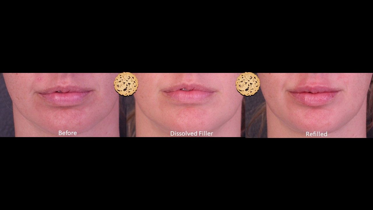 Filler Reversal Before & After