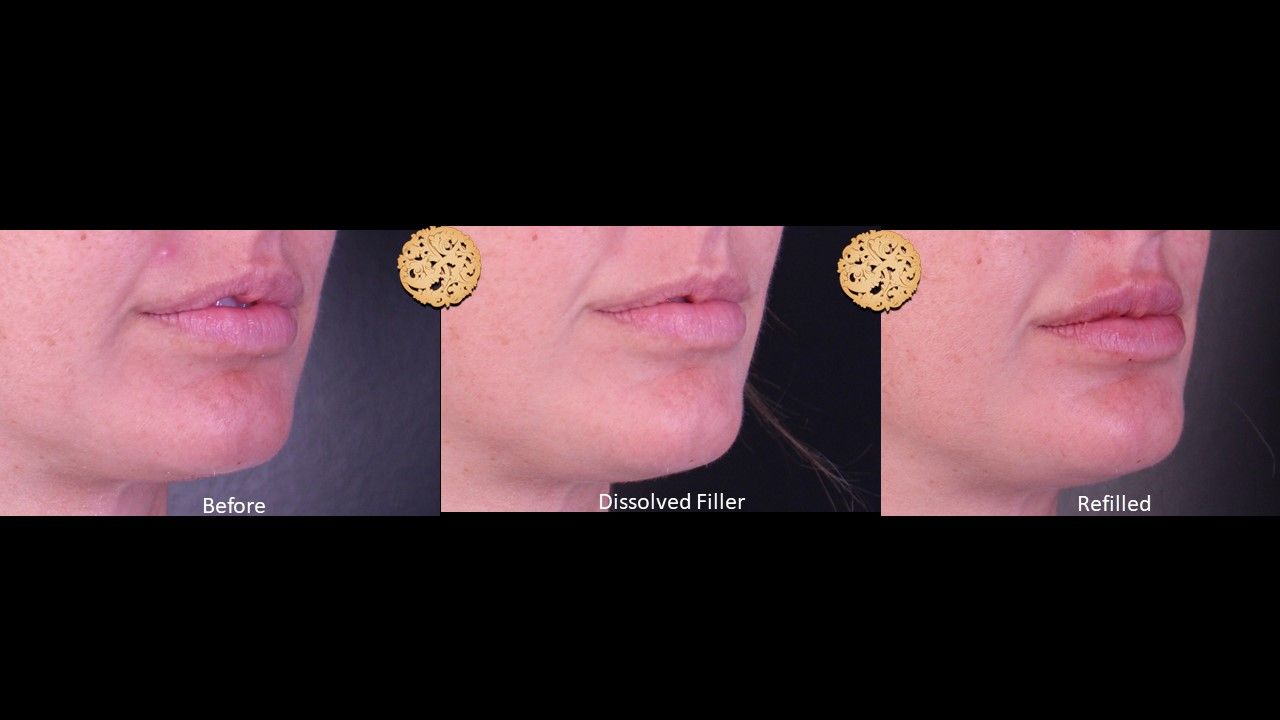 Filler Reversal Before & After