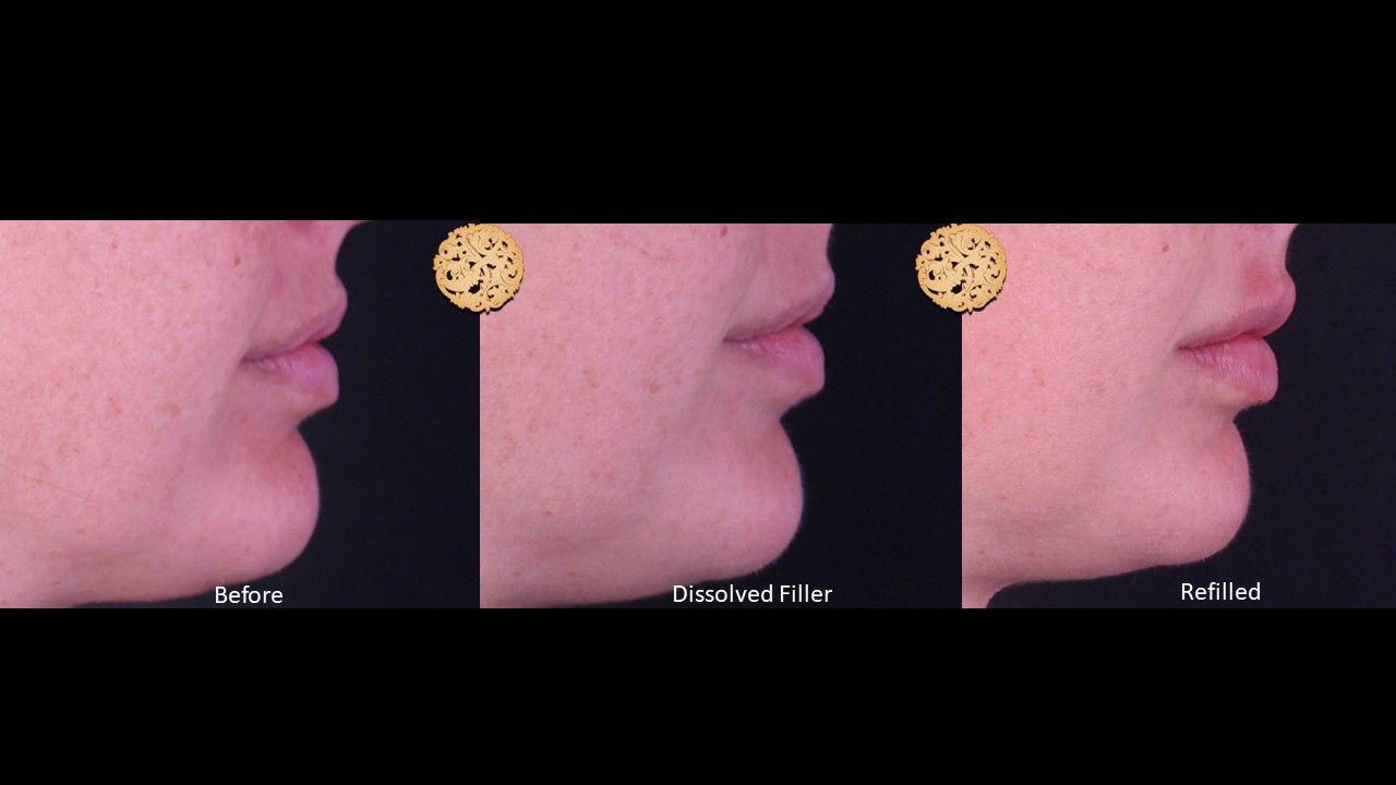 Filler Reversal Before & After