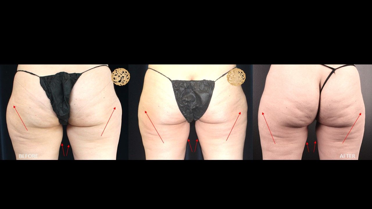 Thigh Coolsculpting Before & After